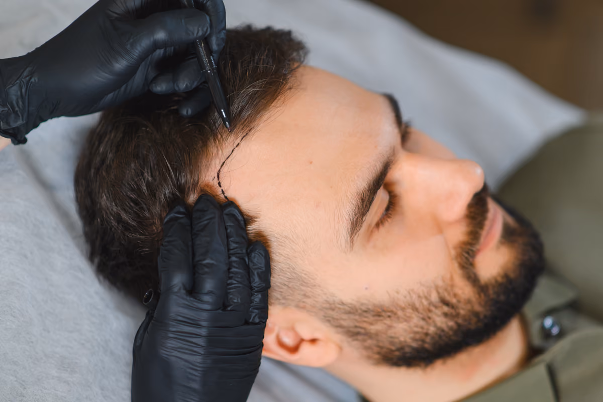 Trapianto di Capelli in Spagna: Perché il Paese è la Nuova Capitale Europea della Chirurgia Estetica